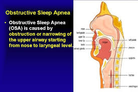 But more alarmingly, some recent studies have shown that people with severe obstructive sleep apnea may be at much greater risk for fatal events such as cancer. Epiglottis A Little Cause Of Obstructive Sleep Apnea
