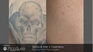 Recognised as the fastest and most effective laser tattoo removal treatment in the world, it can remove tattoos up to 75% faster than. Things You Should Know Before Getting Tattoo Removal Treatment In Sydney