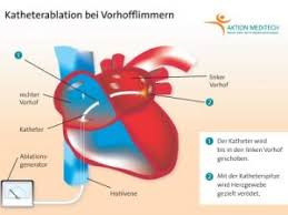 Selten, aber besonders gefährlich sind herzrhythmusstörungen, die direkt in der herzkammer entstehen. Was Hilft Bei Vorhofflimmern Ratgeber Gesundheit Ratgeber Gesundheit