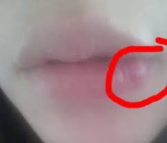 Größtenfalls ist er etwa 0,5cm groß. Mit Bild Komischer Knubbel Knoten In Der Lippe Was Kann Das Sein Tumor