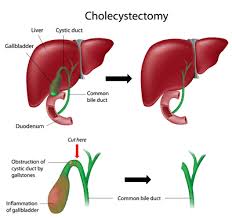 Our hospitals network and surgery group are available in 15 cities of india for our patients to access. Gall Bladder Removal Surgery India Cost Bladder Surgery
