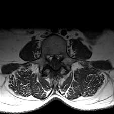 Ligamentum flavum thickness greater than 4 mm on ct imagery is defined as ligamentum flavum hypertrophy. Ligamentum Flavum Cyst Radiology Case Radiopaedia Org