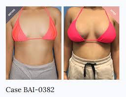 Image result for Breast Augmentation