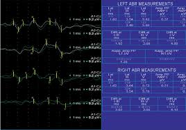 Normal Auditory Brainstem Response Abr And Audiometry