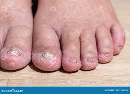 Image result for Koilonychia feet