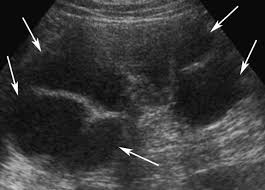 Image result for Genitourinary Tuberculosis