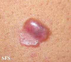 Symptoms of basal cell carcinoma appear on areas exposed to the sun, such as the head, face, neck, arms, and hands. Skin Sun Damage Symptoms And Pictures Healthhype Com