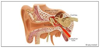 Image result for Eustachian Tube Dysfunction
