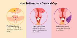 Image result for Cervical Cap