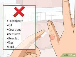 How To Treat A Blistering Burn On Your Finger: 14 Steps