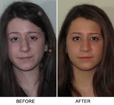 After surgery to remove polyps in the nose and the patient will have to undergo rehabilitation at the clinic. Broken Nose Before And After New York Ny Sinus Surgeon