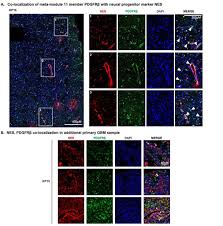 Glioblastoma Neurovascular Progenitor Orchestrates Tumor Cell Type  Diversity