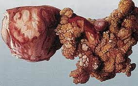The arkansas ovarian cancer coalition is striving to make a difference in ovarian cancer. Researchers Find Genes Linked To Ovarian Cancer Lifestyle Health Emirates24 7