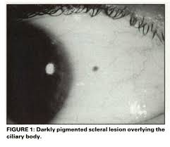 Image result for lesion sclera