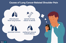 It is a deadly and very aggressive form of cancer where unlike most cancer diagnoses there is no cure and the person that has contracted it is left with a certain outcome to their illness. When Might Shoulder Pain Be A Sign Of Lung Cancer Or Mesothelioma