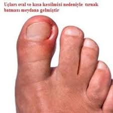 Tirnak Yataginin Herhangi Bir Sekilde Bozulmasi Tirnagin Yuvasi Icerisinde Duzgun Bir Sekilde Ilerlemesini Bozar Bu Tirnagin Yuv Tirnak Batmasi Tirnak Saglik