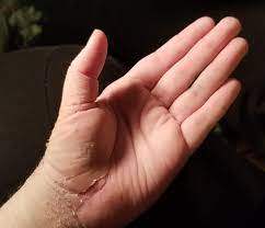 Under the skin / cast Peeling Skin After Swelling From Hand Surgery This Is Right After Cast Was Removed Peeling