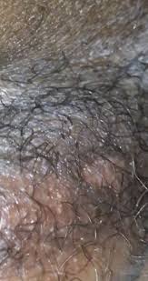 Best way to treat hsv2 outbreak? hsv 2: Help Hsv 2 Picture Attached Genital Herpes Simplex Forums Patient