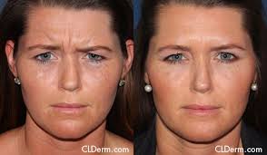 We did not find results for: Before After Botox And Dysport Photos San Diego Cldermatology Botox Botox Before And After Cosmetic Dermatology