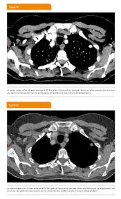 Le scanner, aussi appelé tomodensitométrie, est un examen qui donne des images en coupe d'un organe. La Tdm A Double Energie Ou Spectrale Louvain Medical