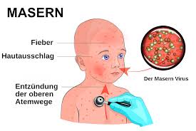 Wir erklären, welche gefahr dem baby droht und wie steckt man sich mit ringelröteln an? Ratgeber Masern Ansteckung Symptome Und Krankheitsverlauf