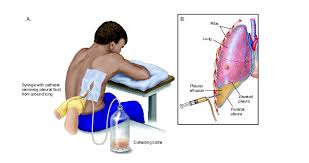 Image result for Thoracentesis