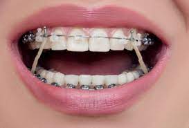 Maybe you would like to learn more about one of these? Pakai Braces Akhirnya