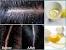 How To Remove Dandruff In One Day