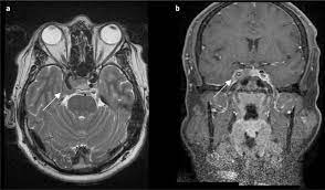 La trombosis del seno cavernoso se trata con antibióticos intravenosos en altas dosis, administrados a través de una vena (iv) si la causa es una infección. Sindrome Del Seno Cavernoso Como Inicio De Un Linfoma De Burkitt A Proposito De Un Caso Y Revision De La Bibliografia Neurologia Com