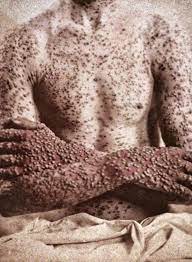 In 1959, the world health organization (who) started a plan to rid the world of smallpox. Il Primo Vaccino Della Storia Edward Jenner E La Lotta Contro Il Vaiolo