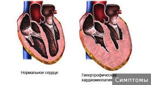 Alkogolnaya Kardiomiopatiya Prichiny Razvitiya Soputstvuyushie Simptomy Metody Obsledovaniya I Lecheniya
