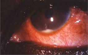 Image result for Ciliary Flush