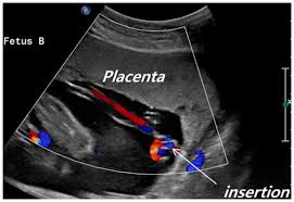 Neither velamentous nor marginal cord insertion was associated with preterm delivery (rr=1. Jcm Free Full Text Clinical Significance Of Velamentous Cord Insertion Prenatally Diagnosed In Twin Pregnancy Html