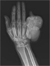 Aneurysmal bone cyst (abc) is a osteolytic bone lesion that rarely involves the jaws. Huge Aneurysmal Bone Cyst Secondary To Giant Cell Tumor Of The Hand Phalanx A Case Report And Related Literature Bmc Cancer Full Text