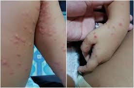 Infeksi virus merupakan penyakit infeksi yang disebabkan oleh masuknya virus ke dalam tubuh manusia. Paula Bingung Kiano Bisa Positif Flu Singapura Ternyata Ini Penyebab Dan Gejalanya Semua Halaman Grid Health