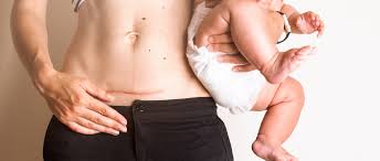 Study Women With Endometriosis Face Double The Rate Of C Sections Endofound