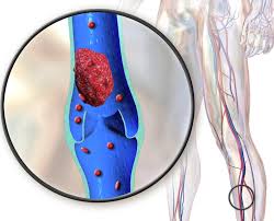 Trombose is de afsluiting van een ader of slagader door een bloedprop (trombus). O Que E Trombose 7 Pontos Para Entender Esse Problema Circulatorio Revista Galileu Saude