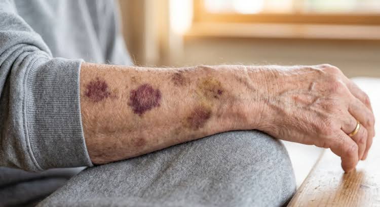 Senile purpura on fragile forearms, AI generated