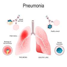 Image result for Pneumonia