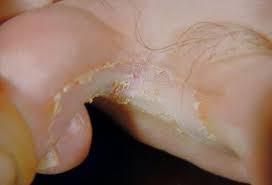 This possibly is the first green fungus case in the country, a local health department official, apoorva tiwari said, as quoted by india's ani news agency. Pictures Of Skin Diseases And Problems Athlete S Foot