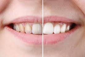 Find out how you can both whiten. Teeth Whitening After Braces San Ramon Ca Dr Carol Jin Dds