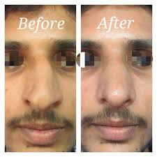 Although the cost of the nose reshaping surgery is largely dependent on the complexity of the surgery, it will cost you about rs. What Is The Cost Of Nose Surgery