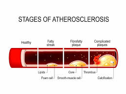 how to lower your cholesterol levels saga