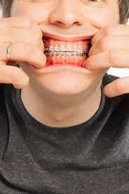 How do i stop my teeth hurting with braces? Pain Relief For Sore Lips Cheeks Or Tongues From Braces