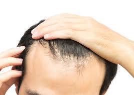 Most causes of hair loss in men can be attributed to one of the following reasons: What Causes Hair Loss 10 Major Reasons With Treatments Rephair