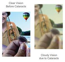 You can see how to get to carolina vision center on our website. Dr Michael G Woodcock Laser Cataract Surgery In Fayetteville Nc