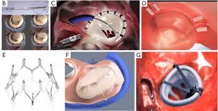 Tomas gonzalez was born in maracaibo, venezuela, but has lived most of his life in san jose, costa rica. New Devices For Transcatheter Mitral Valve Repair A Carillon B Download Scientific Diagram