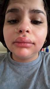 How to Know Your Pierced Lip Is Infected