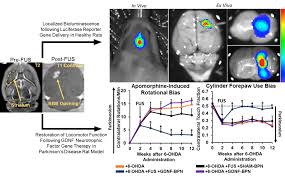 Price Lab Gene Therapy For Parkinson S Disease Via Focused Ultrasound Targeted Nanoparticle Delivery