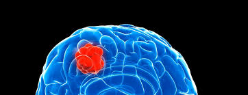 They develop in unique ways and call for. Glioblastoma Multiforme Gbm Advancing Treatment For A Dangerous Brain Tumor Johns Hopkins Medicine